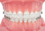 歯と同色の装置