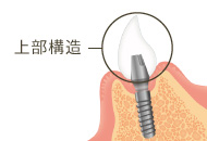 インプラントの上部構造