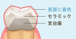 ステイニングタイプ