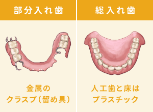部分入れ歯：金属のクラスプ（留め具）、総入れ歯：人工歯と床はプラスチック