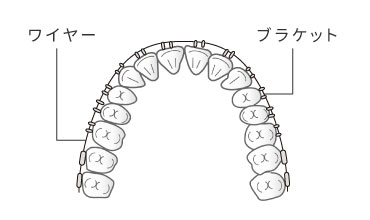 マルチブラケット（表側矯正）