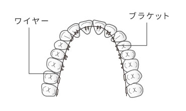 リンガルブラケット(舌側矯正)