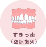 すきっ歯（空隙歯列）