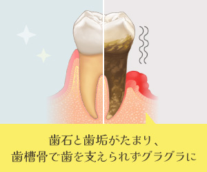 歯石と歯垢がたまり、歯槽骨で歯を支えられずグラグラに