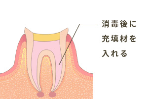 充填剤で密封