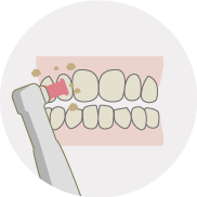 歯のクリーニング 歯垢・歯石の除去